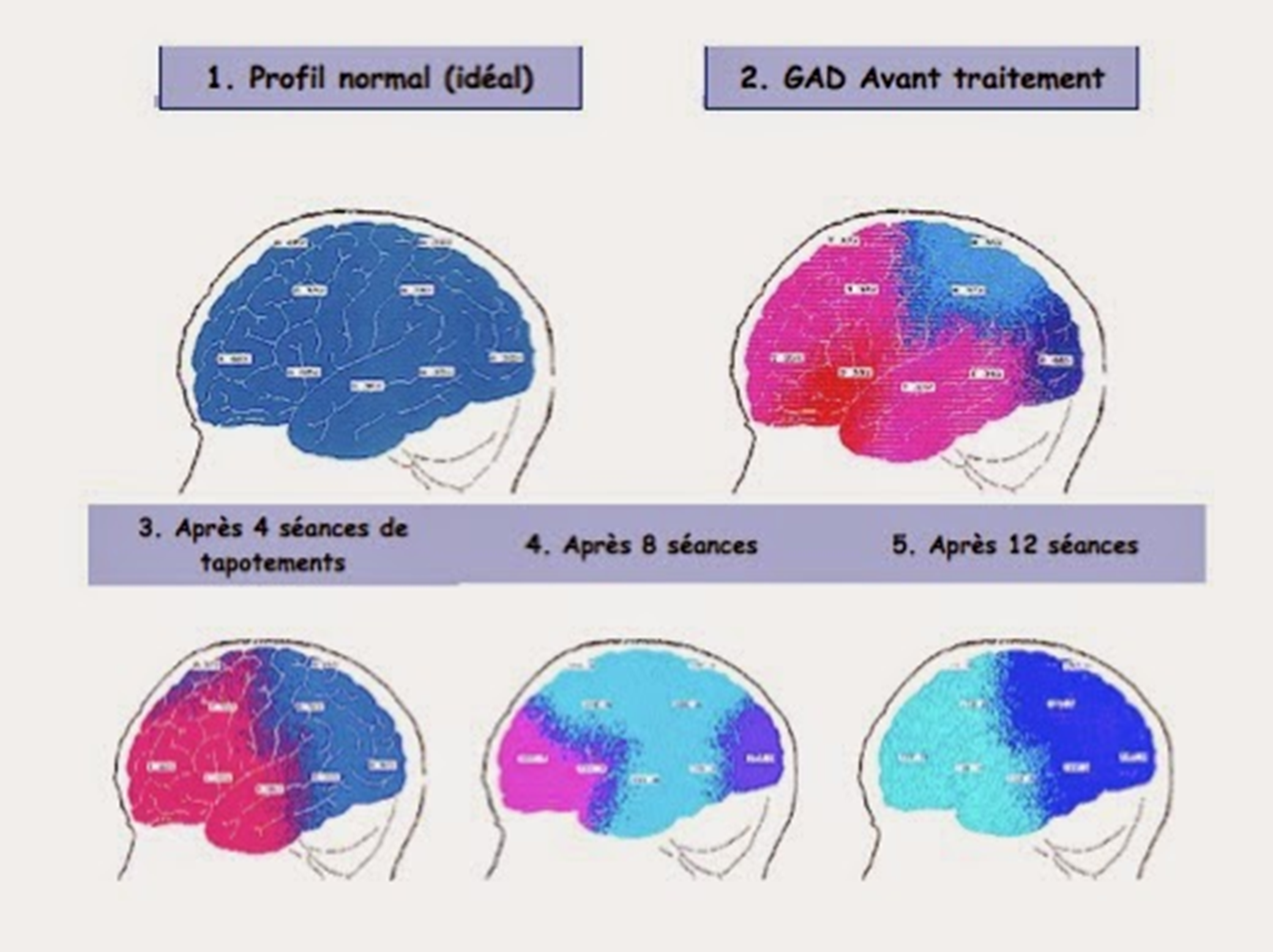 Scans cérébraux (EEG) digitalisés - Joachin Antrade vvvvvvvvv